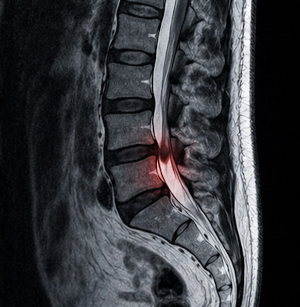 spinal compression