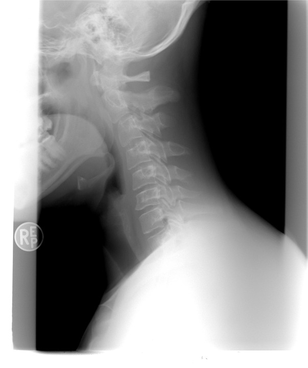 X Ray of chronic neck pain