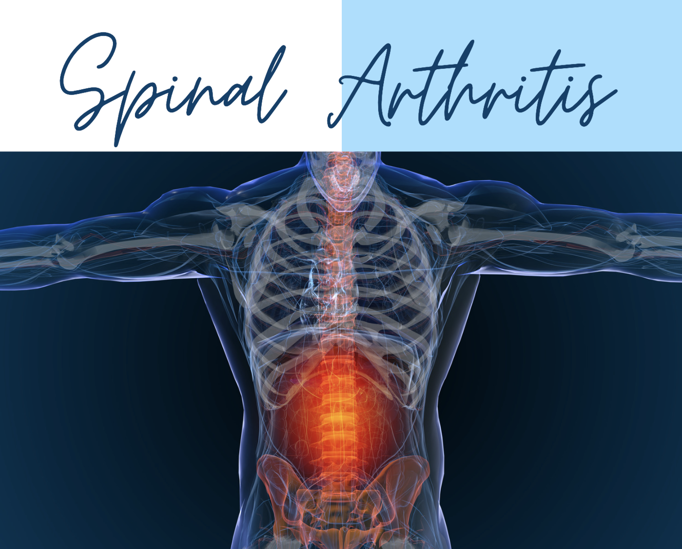 Spinal Arthritis News
